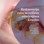Restauracija zuba sa velikim oštećenjima krunice